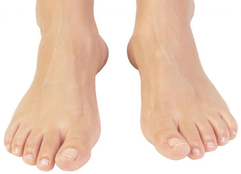 zdravé nechty na nohách po liečbe plesní