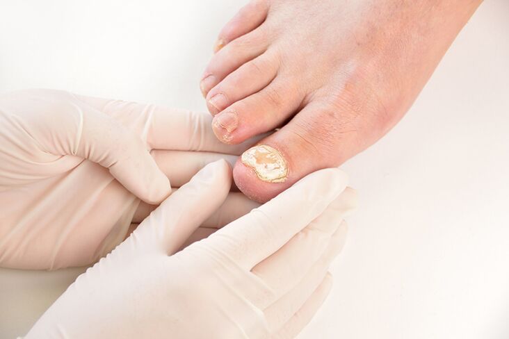 Pred predpísaním liečby musí lekár diagnostikovať hubu nechtov na nohách