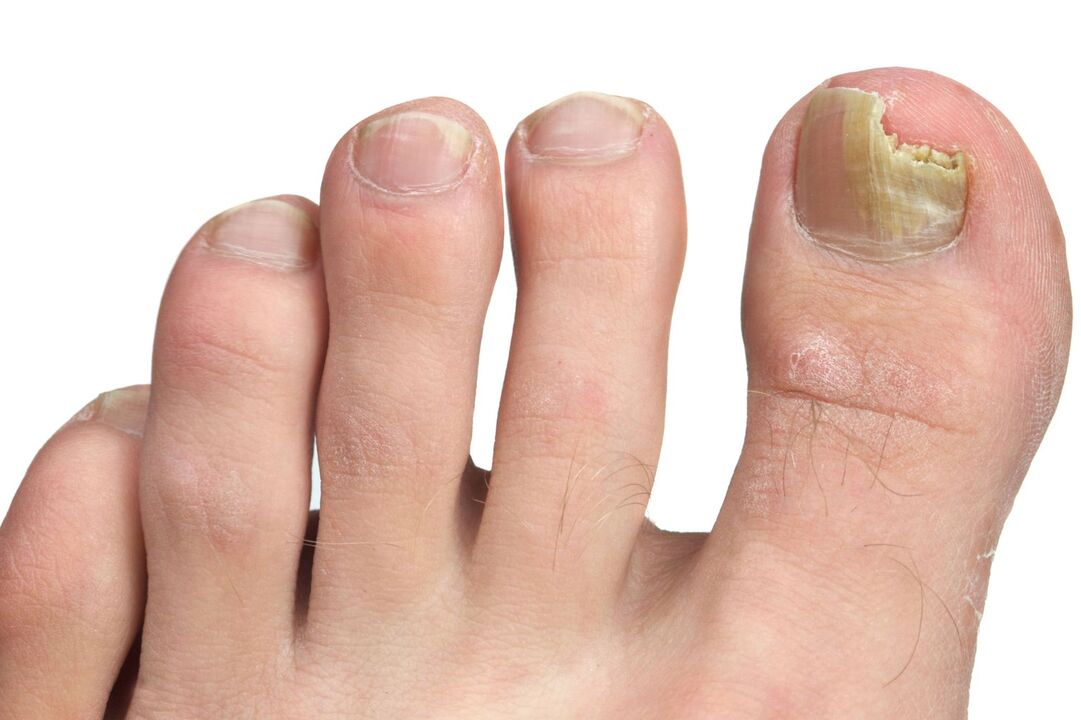 príznaky plesní nechtov na nohách