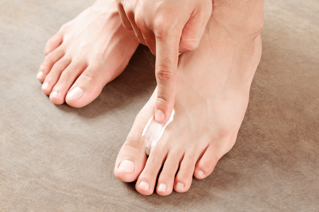 aplikácia antifungálnej masti na pokožku nohy