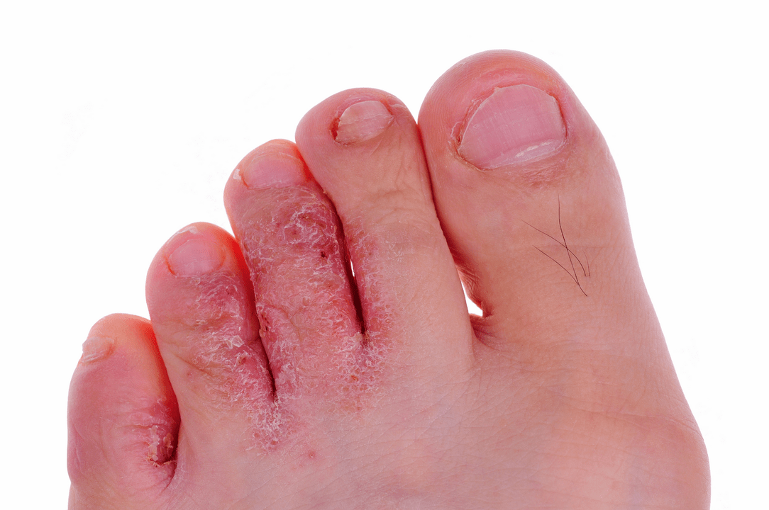 plesňová infekcia kože medzi prstami na nohách