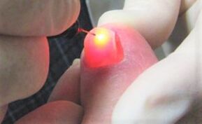 Ošetrenie nechtových húb laserom