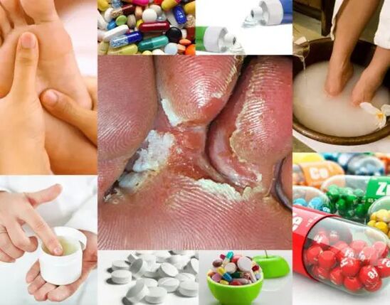 Interdigitálna mykóza a metódy liečby