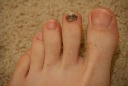 Použitie perorálnych a lokálnych liekov