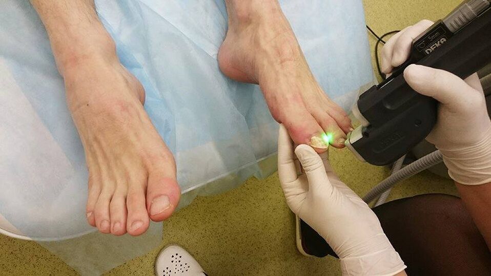 laserová terapia plesní nechtov